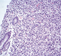 Poorly differentiated adenocarcinoma
