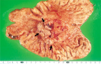 Protruding tumor