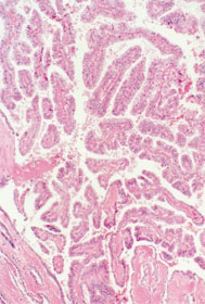 Papillary carcinoma